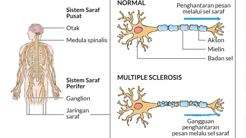 Multiple Sclerosis: Tanda-tanda dan Manajemen dari PAFI Kabupaten Kebumen